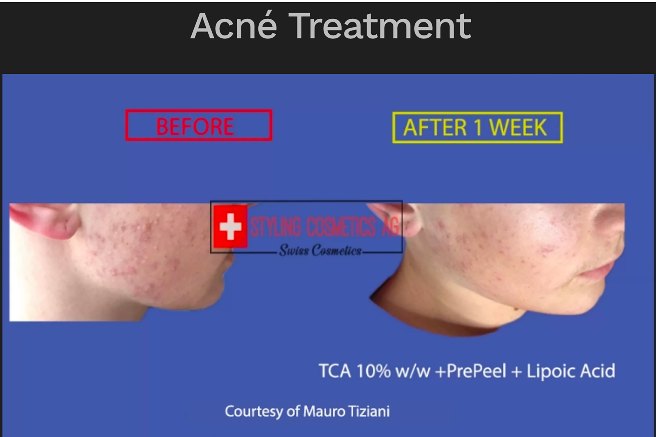 acne tca prepeel lipoic
