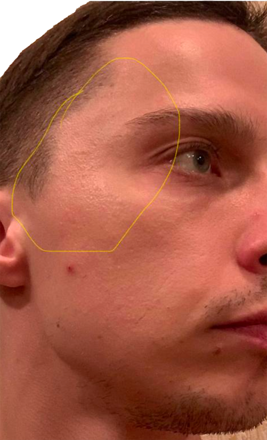 dmitri70-temporal lesions