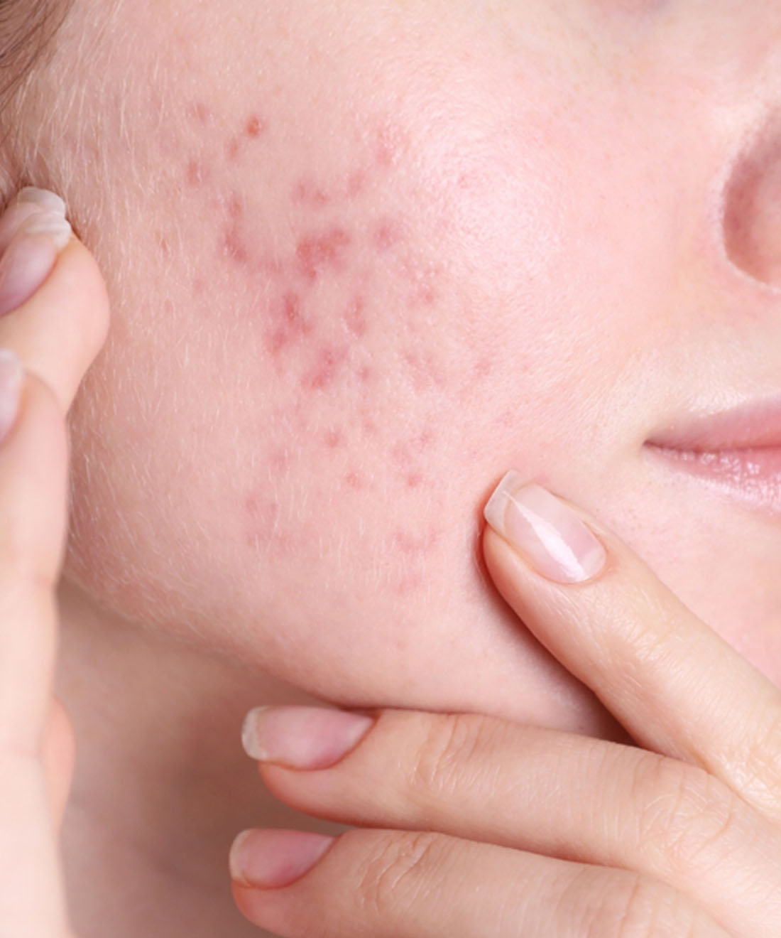 Persistent adult acne in adult female patient with inflammatory lesions on jawline