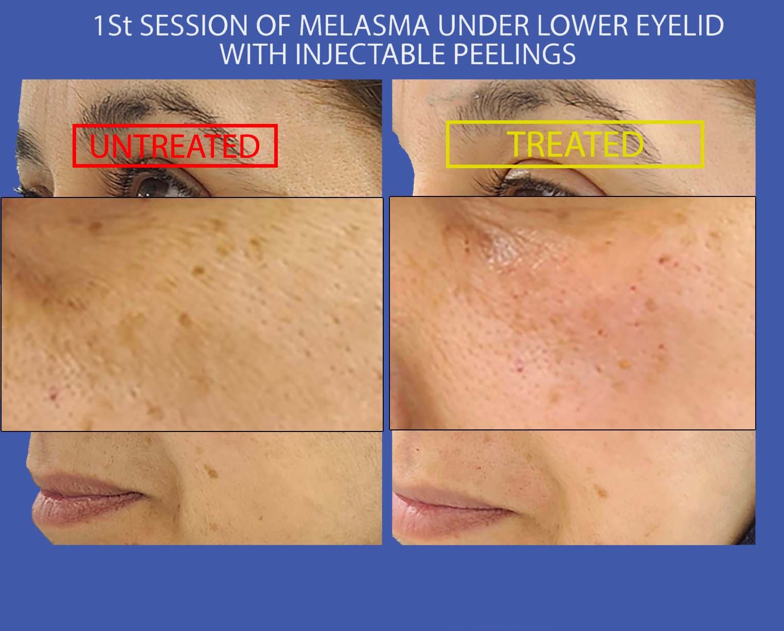 hyperchromies/melasma-poc-L1-zoom