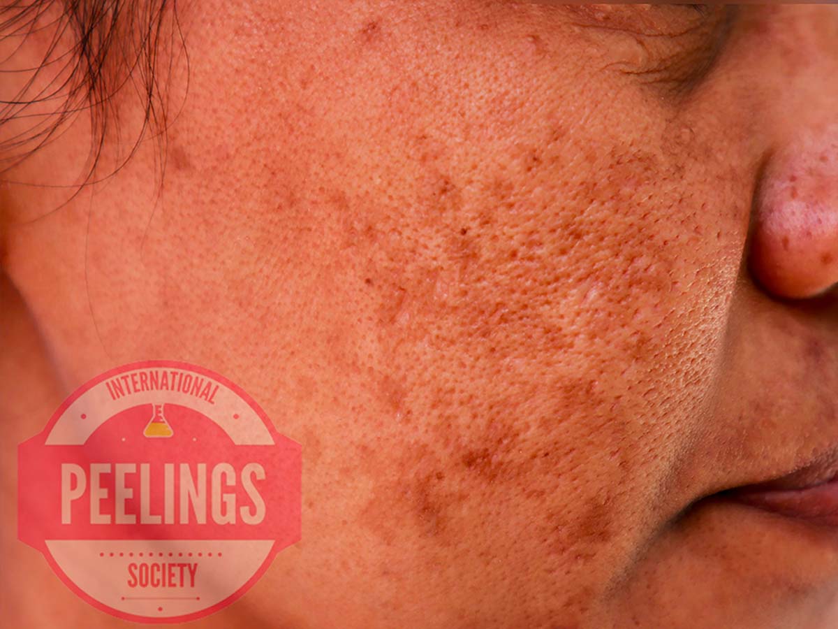 Melasma facial pigmentation indication for chemical peeling