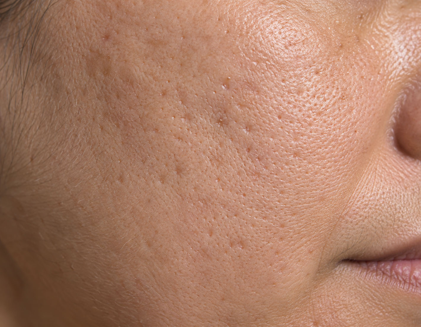Clinical educational visualization of shallow atrophic depressions resembling enlarged pores