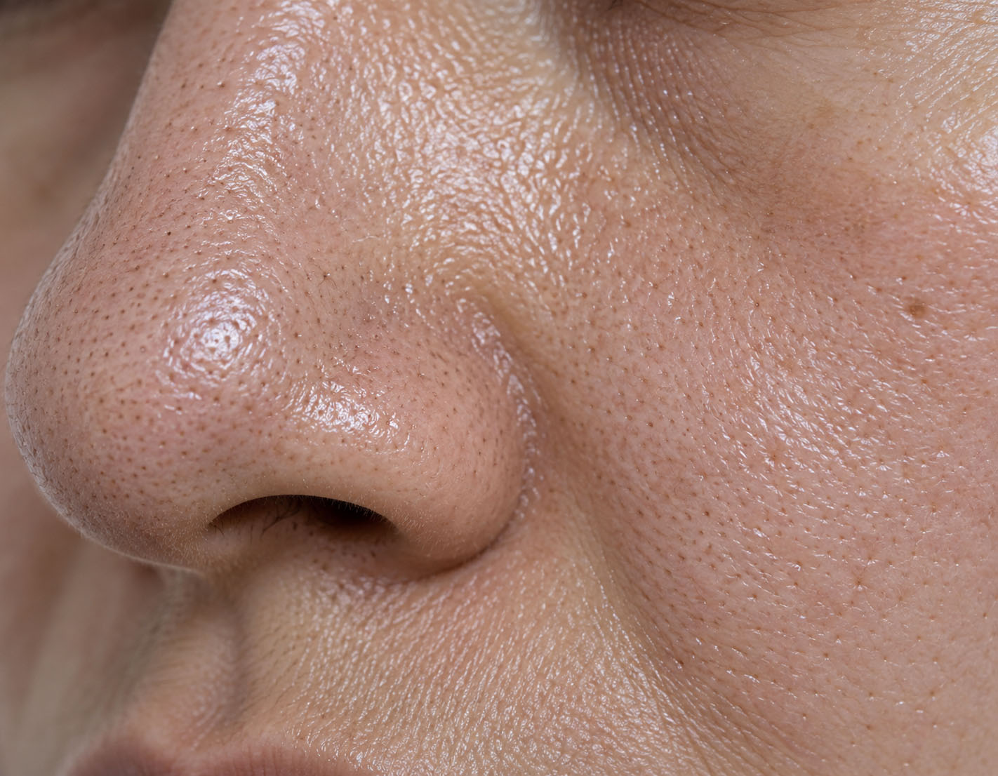 Clinical educational visualization of oily skin with increased sebum and visible follicular openings