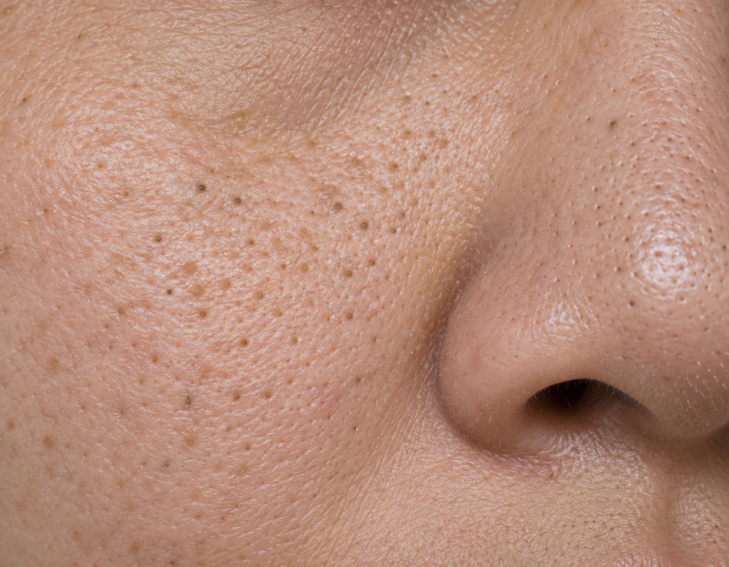 Comedonal enlarged pores with follicular keratin accumulation