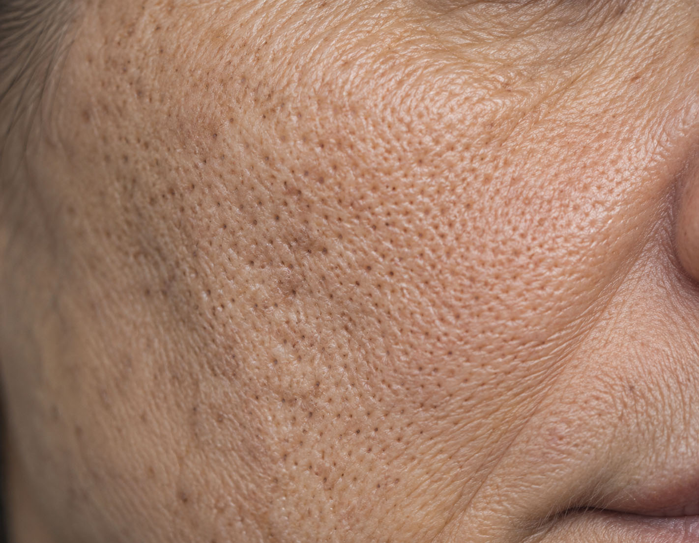 Photo-induced enlarged pores associated with reduced perifollicular support