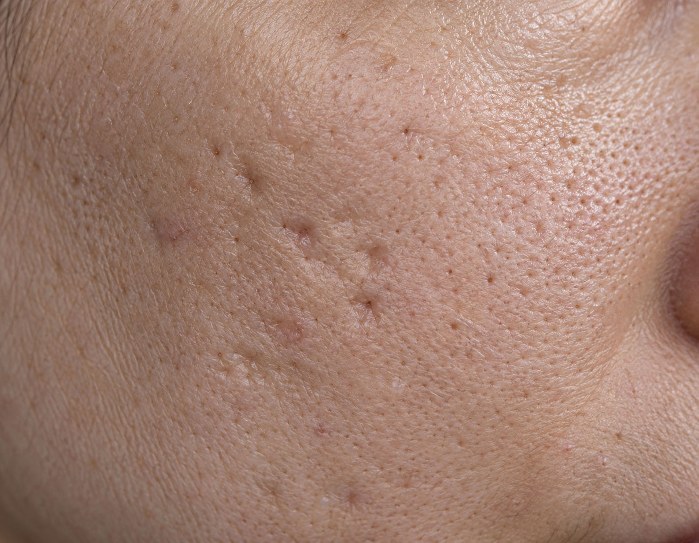 Scar-related pore-like depressions requiring differential diagnosis