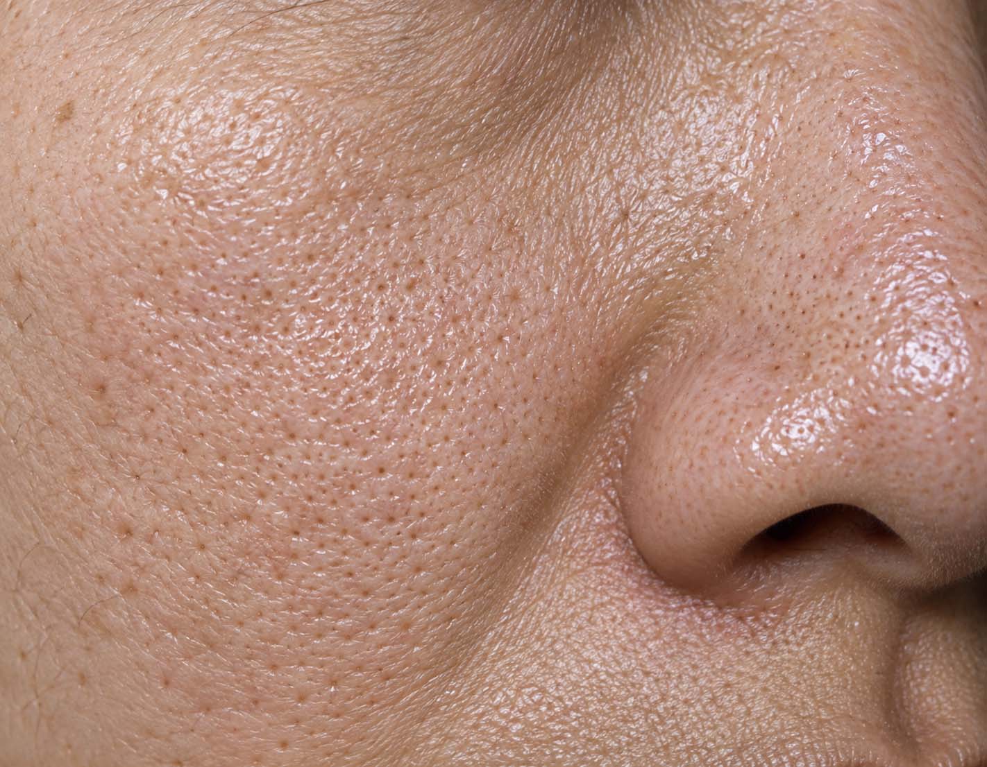 Seborrheic enlarged pores associated with increased surface oil
