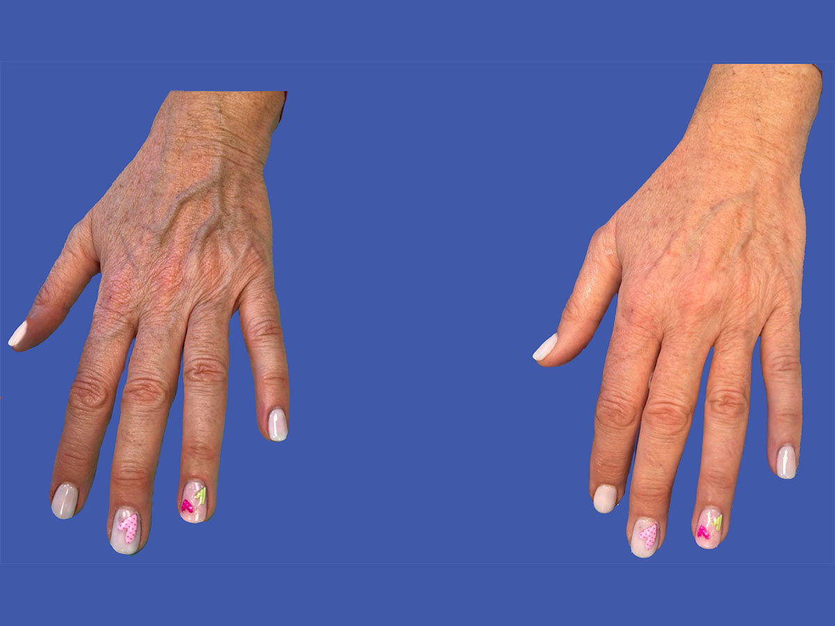 Before and after clinical result following chemical peeling of the hands