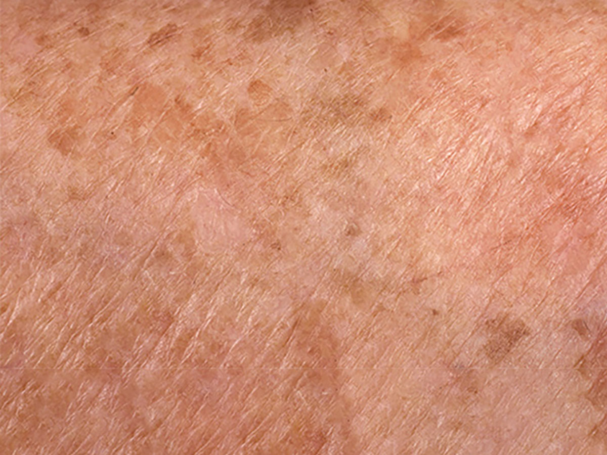 Hyperpigmentation and uneven skin tone indication for chemical peeling