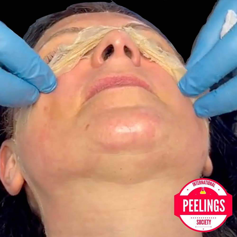 removal of peeling de luxe plus & 30 min peel off