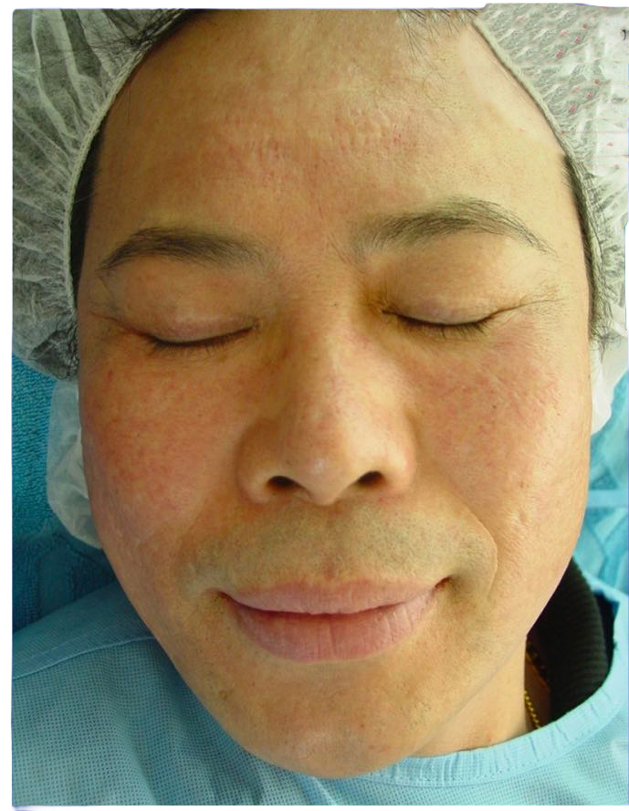 Before advanced peel protocol at day 0