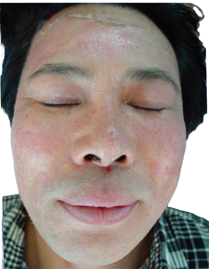 After advanced peel protocol at day 7