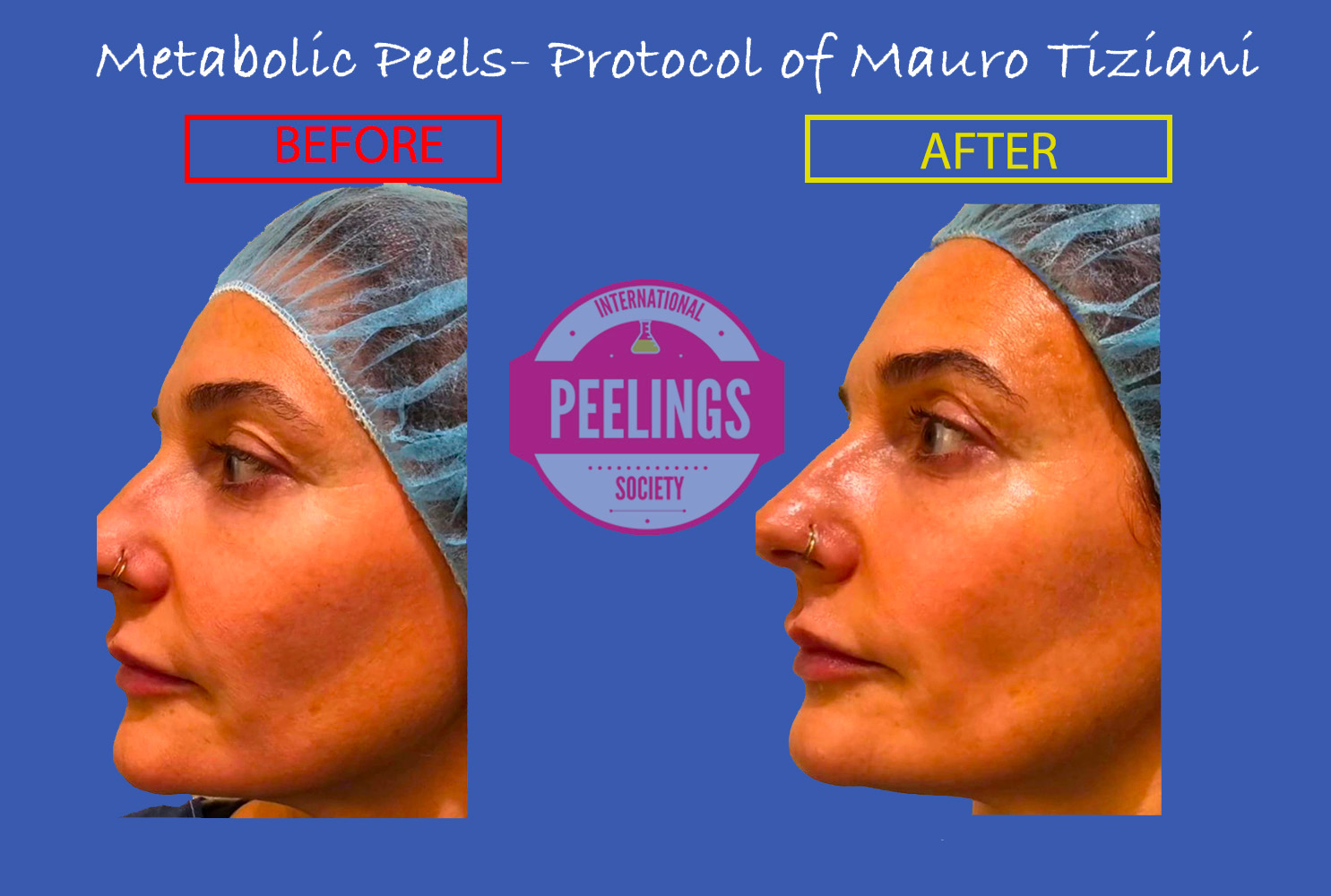 zeynep-metabolic-peel