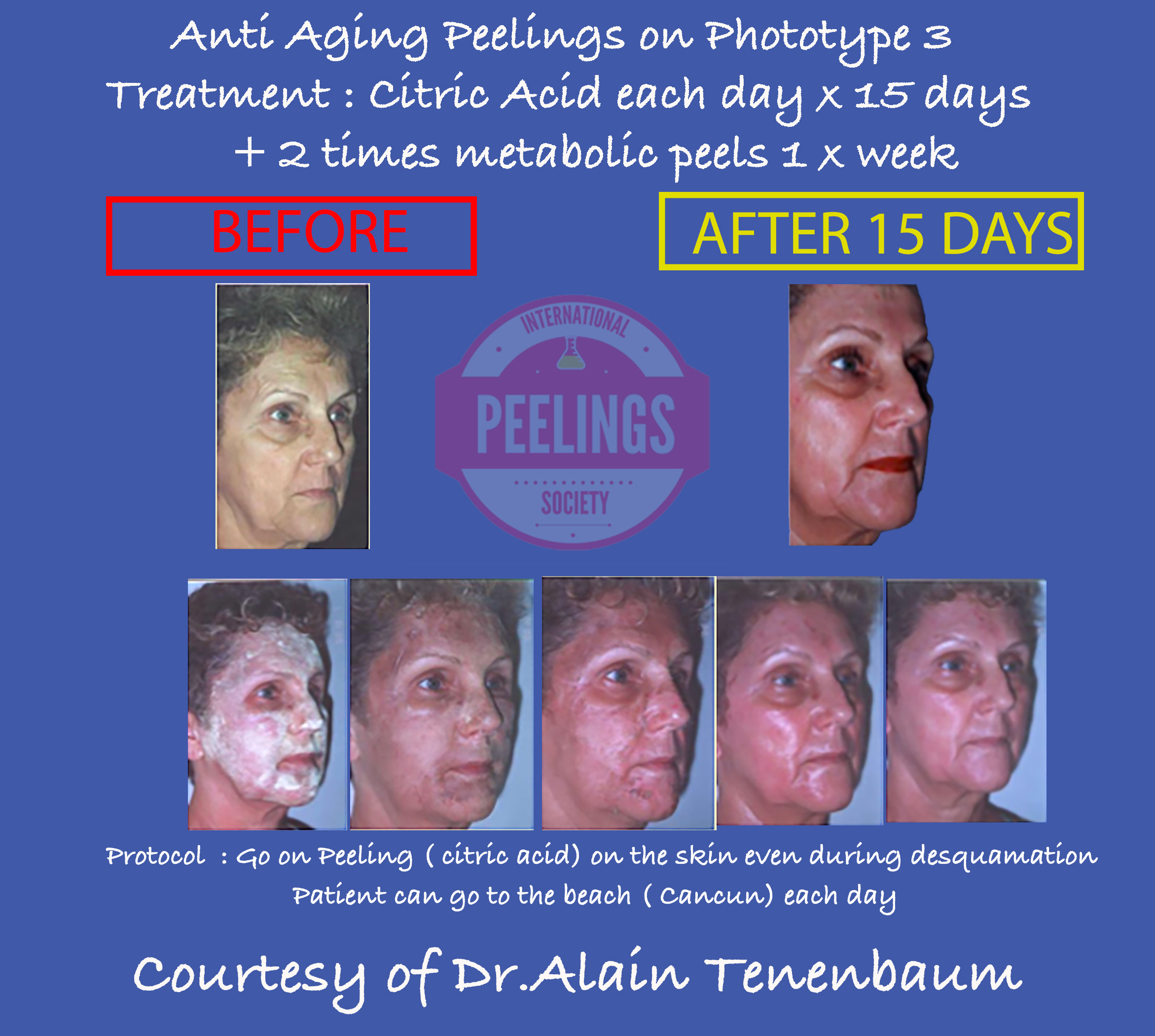details-mexican-female-antiaging-peel