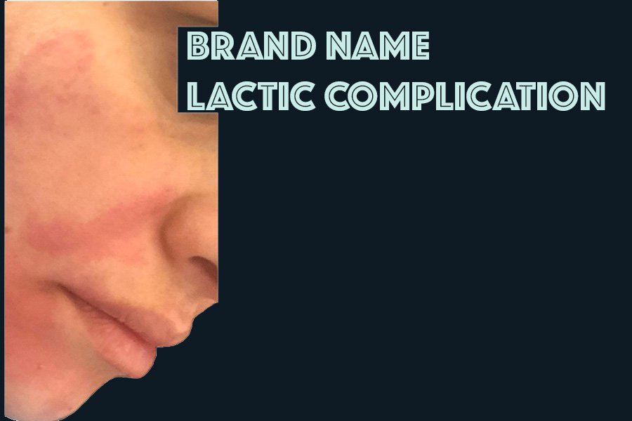 Example of complication related to poorly controlled peel chemistry (lactic acid)