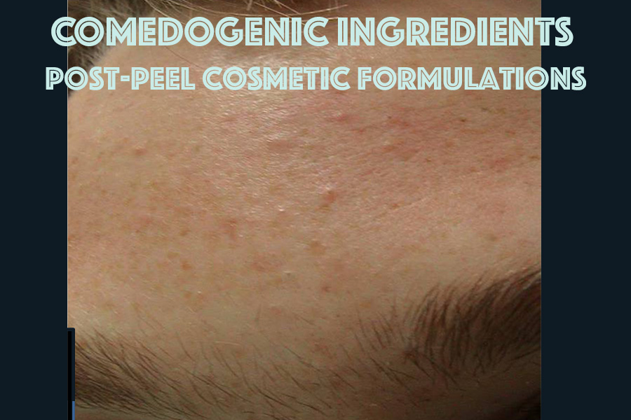 Comedogenic ingredients may trigger breakouts during healing