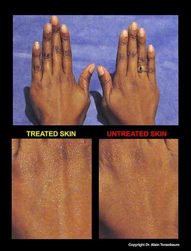 results/peeling-de-luxe4