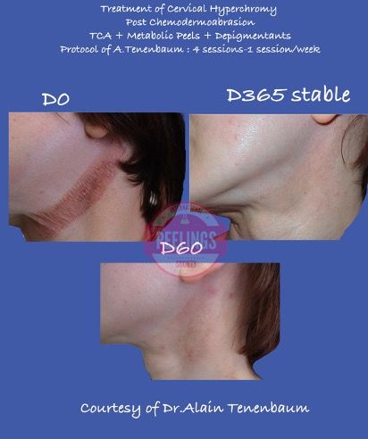 neck-hyperchromy-1y-profile