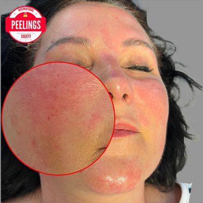 immediately after procedure