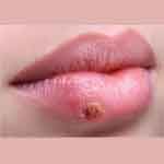 herpes-labialis