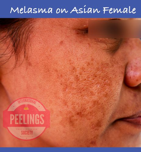 melasma