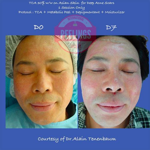 Deep Acne Scars on Asian Male 