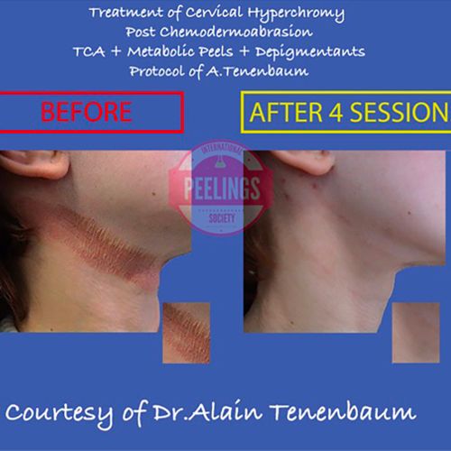 russian-posr-dermabrasion-complication