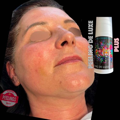 skin aspect at the end of application of peeling de luxe plus