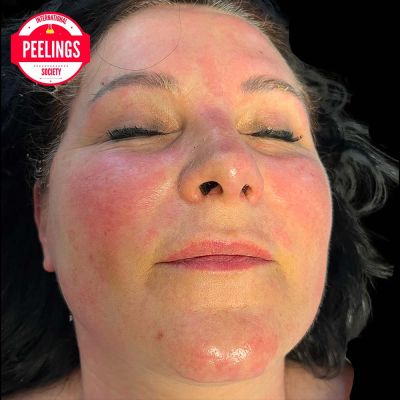 skin aspect at the end of application of 30 min peel off before removal