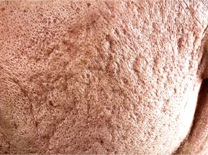 scars and texture disorders