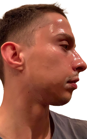 right profile- 45 min after 1 st application- insufficient product 