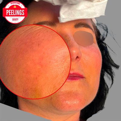  before procedure with zoom