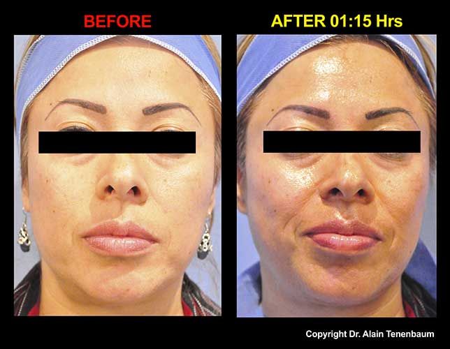 results/peeling-de-luxe1