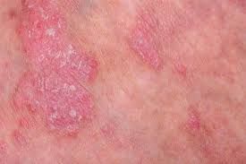 active-skin-disease