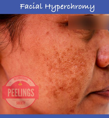 facial hyperchromy