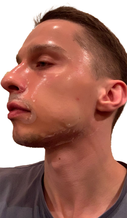 45 min after 1 st application insufficient- left view 