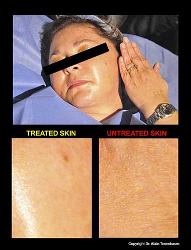 results/peeling-de-luxe3