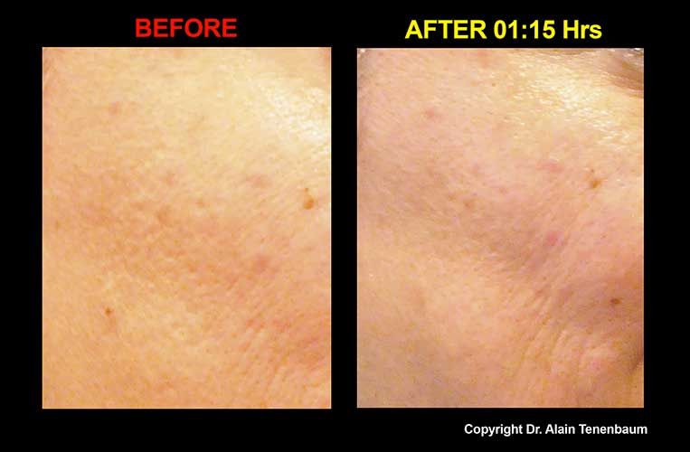 results/peeling-de-luxe5