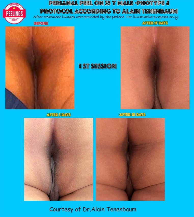 1st-session-perianalpeel-D0-D3-D10-D17