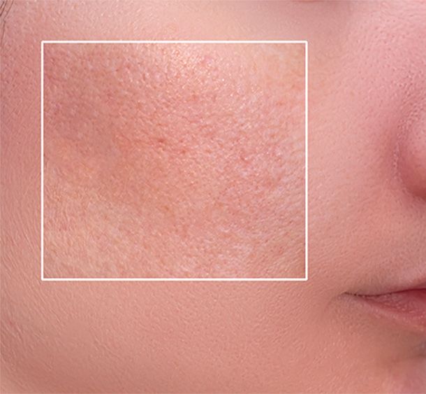 pores