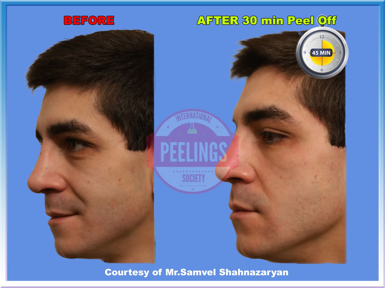 smokers-skin-30minpeeloff-fleft-profile